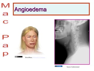 Angioedema
Source Undetermined
BruceBlaus, Wikimedia Commons
 