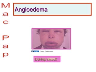 Angioedema
During attack
Source Undetermined
 