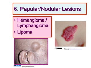 6. Papular/Nodular Lesions
• Hemangioma /
Lymphangioma
• Lipoma
Zeimusu, Wikimedia Commons
Source Undetermined
 