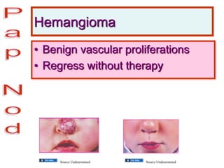 Hemangioma
• Benign vascular proliferations
• Regress without therapy
Source Undetermined Source Undetermined
 