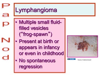 Lymphangioma
• Multiple small fluid-
filled vesicles
(“frog-spawn”)
• Present at birth or
appears in infancy
or even in childhood
• No spontaneous
regression
Source Undetermined
 