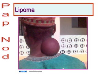 Lipoma
Source Undetermined
 