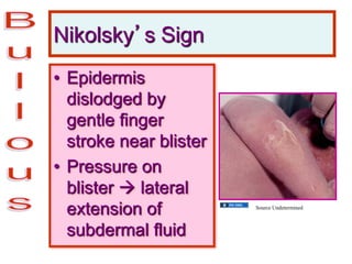 Nikolsky’s Sign
• Epidermis
dislodged by
gentle finger
stroke near blister
• Pressure on
blister  lateral
extension of
subdermal fluid
Source Undetermined
 