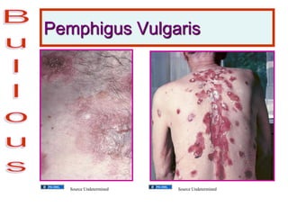 Pemphigus Vulgaris
Source Undetermined Source Undetermined
 