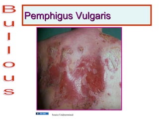 Pemphigus Vulgaris
Source Undetermined
 