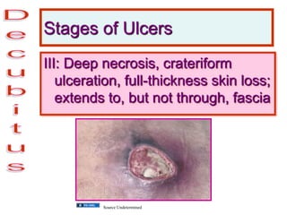 Stages of Ulcers
III: Deep necrosis, crateriform
ulceration, full-thickness skin loss;
extends to, but not through, fascia
Source Undetermined
 