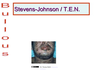 Stevens-Johnson / T.E.N.
Dr. Thomas Habif, Wikimedia
Commons
 