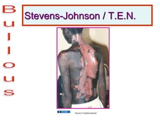 Stevens-Johnson / T.E.N.
Source Undetermined
 