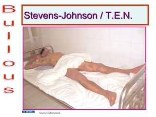 Stevens-Johnson / T.E.N.
Source Undetermined
 