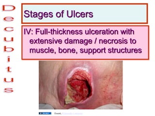Stages of Ulcers
IV: Full-thickness ulceration with
extensive damage / necrosis to
muscle, bone, support structures
Essent, Wikimedia Commons
 