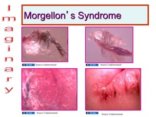 Morgellon’s Syndrome
Source Undetermined Source Undetermined
Source Undetermined
Source Undetermined
 