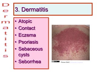 3. Dermatitis
• Atopic
• Contact
• Eczema
• Psoriasis
• Sebaceous
cysts
• Seborrhea Thomas Habif, Wikimedia Commons
 