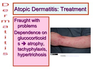 Atopic Dermatitis: Treatment
Fraught with
problems
Dependence on
glucocorticoid
s  atrophy,
tachyphylaxis,
hypertrichosis Eisfelder, Wikimedia Commons
 