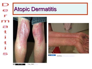 Atopic Dermatitis
Care_SMC, Flickr
Jambula, Wikimedia Commons
 