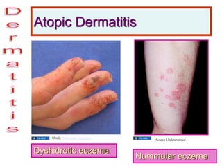 Atopic Dermatitis
Dyshidrotic eczema
Nummular eczema
Dbnll, Wikimedia Commons
Source Undetermined
 