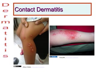Contact Dermatitis
Alborz Fallah, Wikimedia Commons
Nunyabb, Wikimedia Commons
 