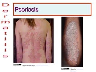 Psoriasis
James Heilman, MD, Wikimedia Commons
MediaJet, Wikimedia
Commons
 