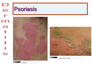 Psoriasis
Eisfelder, Wikimedia Commons
James Heilman, MD, Wikimedia Commons
 