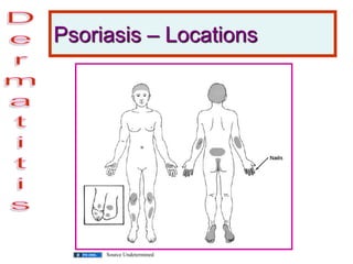 Psoriasis – Locations
Source Undetermined
 