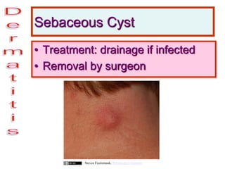 Sebaceous Cyst
• Treatment: drainage if infected
• Removal by surgeon
Steven Fruitsmaak, Wikimedia Commons
 
