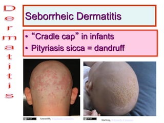 Seborrheic Dermatitis
• “Cradle cap” in infants
• Pityriasis sicca = dandruff
Amras666, Wikimedia Commons
Starfoxy, Wikimedia Commons
 