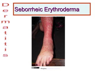 Seborrheic Erythroderma
Nbrigham, Wikimedia Commons
 