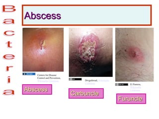 Abscess
Abscess
Furuncle
Carbuncle
Centers for Disease
Control and Prevention,
Wikimedia Commons Drvgaikwad, Wikimedia
Commons El Pantera,
Wikimedia
Commons
 