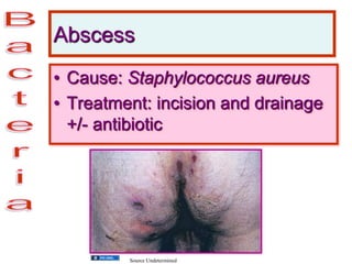 Abscess
• Cause: Staphylococcus aureus
• Treatment: incision and drainage
+/- antibiotic
Source Undetermined
 