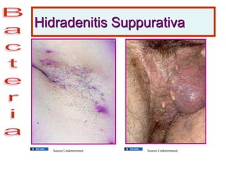 Hidradenitis Suppurativa
Source Undetermined Source Undetermined
 