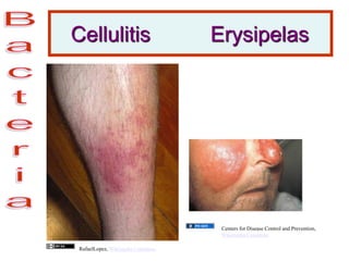 Cellulitis Erysipelas
RafaelLopez, Wikimedia Commons
Centers for Disease Control and Prevention,
Wikimedia Commons
 