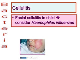 Cellulitis
• Facial cellulitis in child 
consider Haemophilus influenzae
Source Undetermined
 