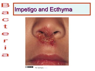 Impetigo and Ecthyma
The Apologue, Flickr
 