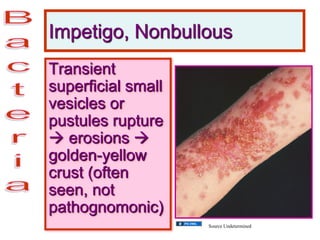 Impetigo, Nonbullous
Transient
superficial small
vesicles or
pustules rupture
 erosions 
golden-yellow
crust (often
seen, not
pathognomonic)
Source Undetermined
 