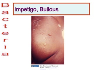 Impetigo, Bullous
U.S. Department of Health and
Human Services, Wikimedia
Commons
 