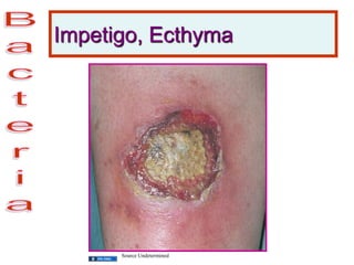 Impetigo, Ecthyma
Source Undetermined
 