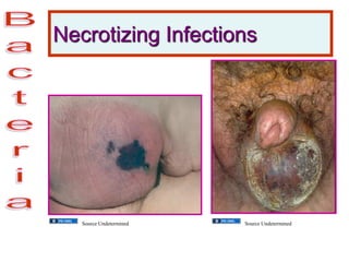 Necrotizing Infections
Source Undetermined Source Undetermined
 