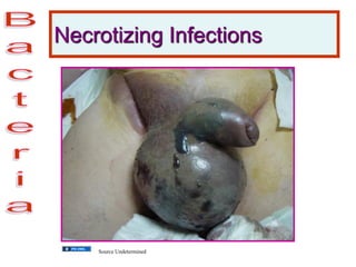 Necrotizing Infections
Source Undetermined
 