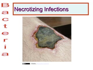 Necrotizing Infections
Chaldor, Wikimedia Commons
 
