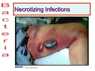 Necrotizing Infections
Source Undetermined
 