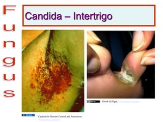 Candida – Intertrigo
Centers for Disease Control and Prevention,
Wikimedia Commons
Grook da Oger, Wikimedia Commons
 