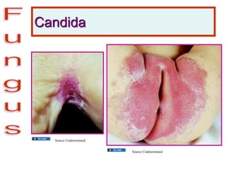 Candida
Source Undetermined
Source Undetermined
 