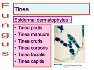 Tinea
• Tinea pedis
• Tinea manuum
• Tinea cruris
• Tinea corporis
• Tinea facialis
• Tinea capitis
Epidermal dermatophytes
Centers for Disease Control and
Prevention, Wikimedia Commons
 
