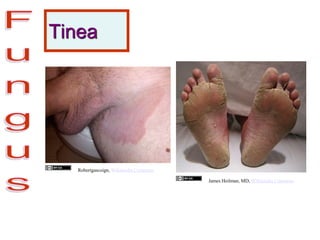 Tinea
Robertgascoign, Wikimedia Commons
James Heilman, MD, Wikimedia Commons
 