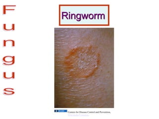 Ringworm
Centers for Disease Control and Prevention,
Wikimedia Commons
 