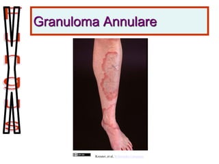 Granuloma Annulare
Kreuter, et al, Wikimedia Commons
 