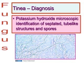 Tinea – Diagnosis
• Potassium hydroxide microscopic
identification of septated, tubelike
structures and spores
Source Undetermined
 