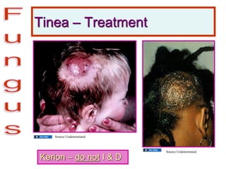 Tinea – Treatment
Kerion – do not I & D
Source Undetermined
Source Undetermined
 