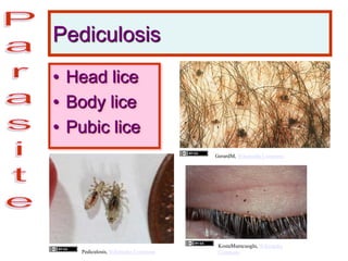 Pediculosis
• Head lice
• Body lice
• Pubic lice
Pediculosis, Wikimedia Commons
GerardM, Wikimedia Commons
KostaMumcuoglu, Wikimedia
Commons
 