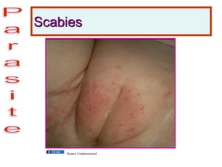 Scabies
Source Undetermined
 