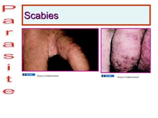 Scabies
Source Undetermined
Source Undetermined
 